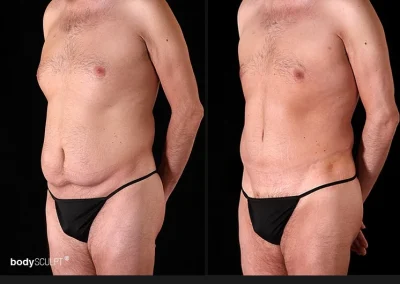 Tummy Tuck for Men