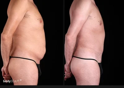 Tummy Tuck for Men