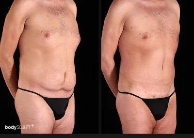 Tummy Tuck for Men