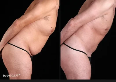 Tummy Tuck for Men