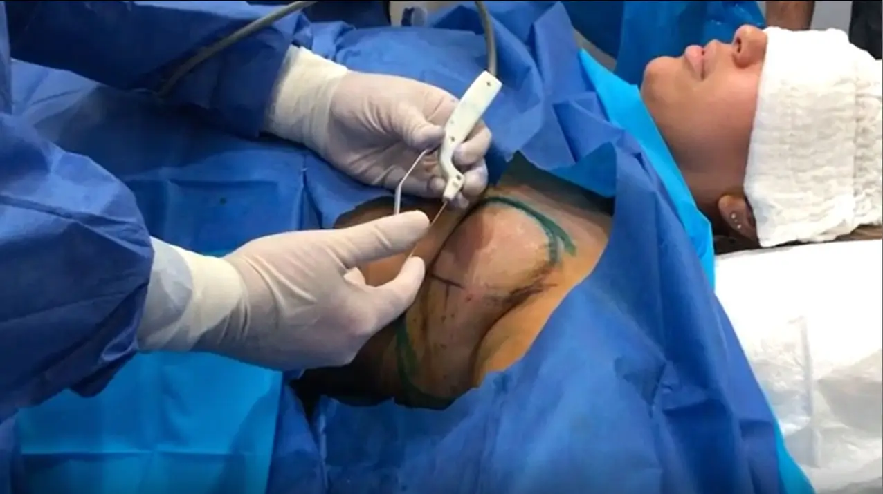 AccuTite Axillary Fat Removal Video: Patient 1
