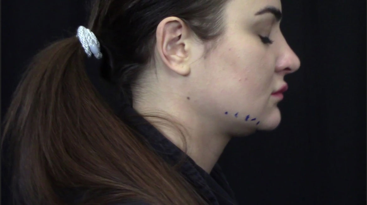AccuTite Facial Contouring Video – Patient 1