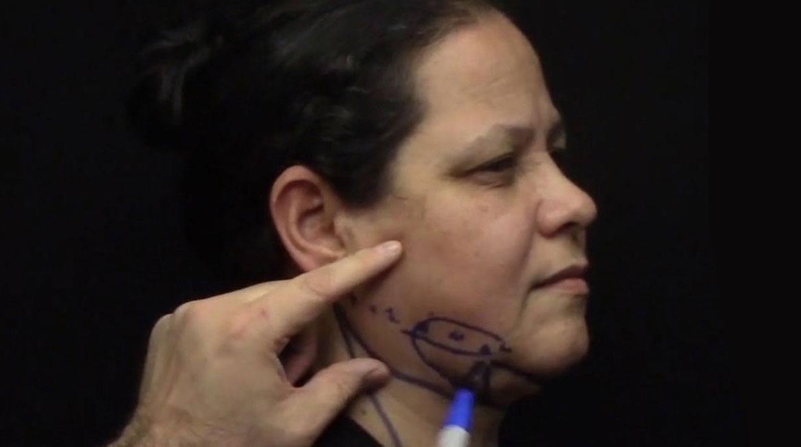 AccuTite Facial Contouring Video – Patient 2