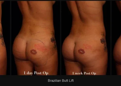 Brazilian Butt Lift – Before & After Photos