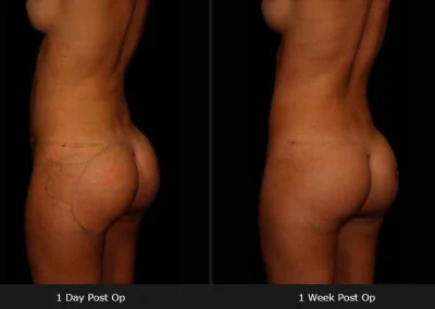 Brazilian Butt Lift – Before & After Photos
