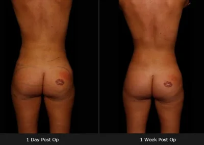 Brazilian Butt Lift – Before & After Photos