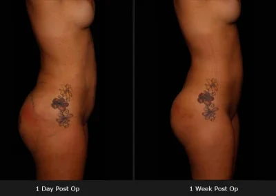 Brazilian Butt Lift – Before & After Photos