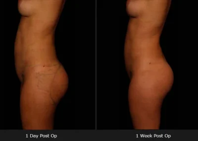 Brazilian Butt Lift – Before & After Photos