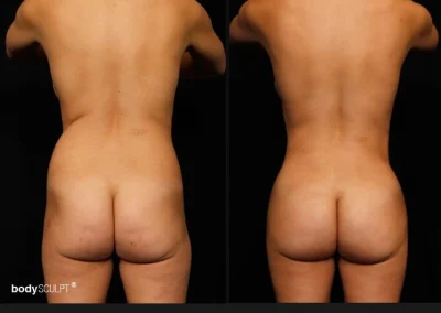 Brazilian Butt Lift – Before & After Photos