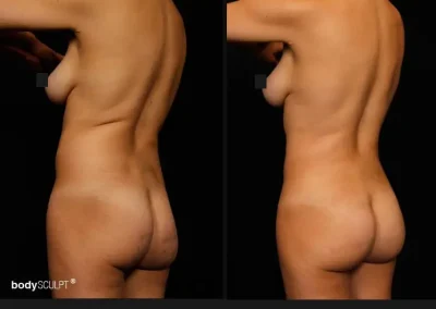Brazilian Butt Lift – Before & After Photos