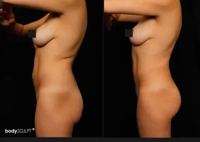 Brazilian Butt Lift – Before & After Photos