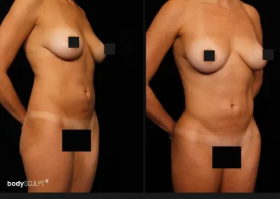 Brazilian Butt Lift – Before & After Photos