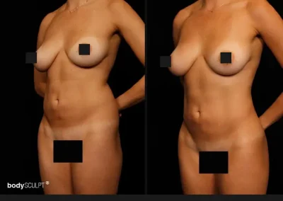 Brazilian Butt Lift – Before & After Photos