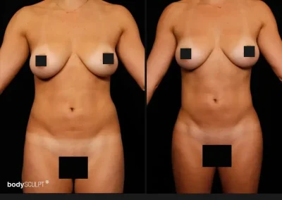 Brazilian Butt Lift – Before & After Photos