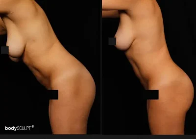 Brazilian Butt Lift – Before & After Photos