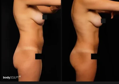 Brazilian Butt Lift – Before & After Photos