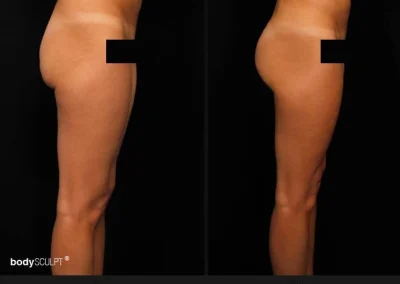 Brazilian Butt Lift – Before & After Photos