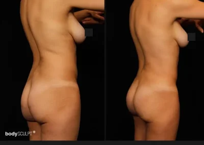 Brazilian Butt Lift – Before & After Photos