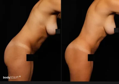 Brazilian Butt Lift – Before & After Photos