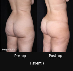 Brazilian Butt Lift – Patient 7