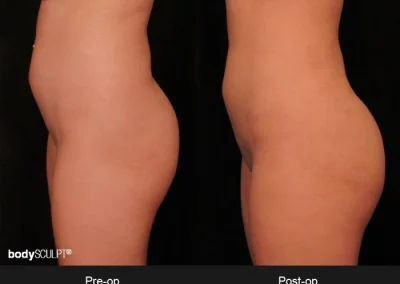 Brazilian Butt Lift – Before & After Photos