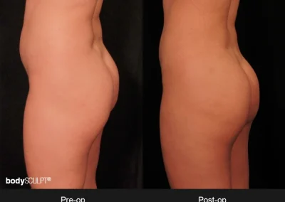 Brazilian Butt Lift – Before & After Photos