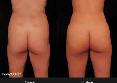 Brazilian Butt Lift – Before & After Photos