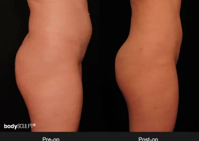 Brazilian Butt Lift – Before & After Photos