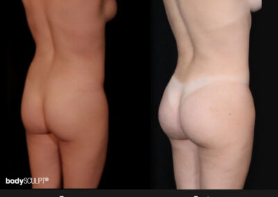 Transformative Results with BBL and Abdominal Liposuction