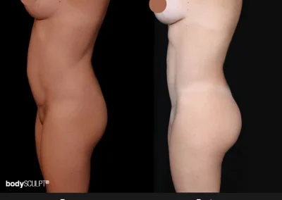 Transformative Results with BBL and Abdominal Liposuction