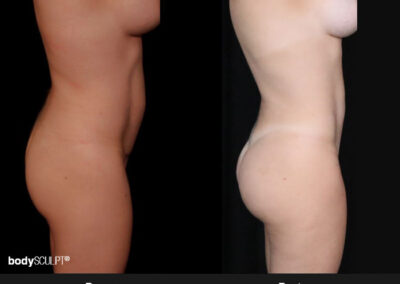 Transformative Results with BBL and Abdominal Liposuction