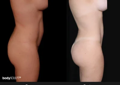 Transformative Results with BBL and Abdominal Liposuction