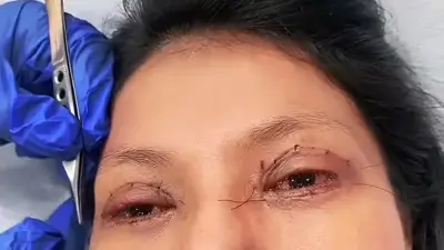 Blepharoplasty Before and After Videos Patient 1