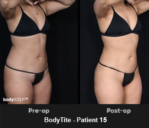 BodyTite Liposuction on Flanks – Patient 15 Before & After Photos
