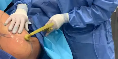 Scarless Arm Lift using BodyTite - Video 2