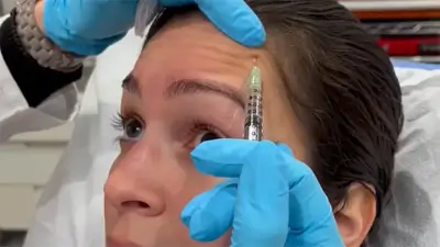 Botox Injections - Patient 3