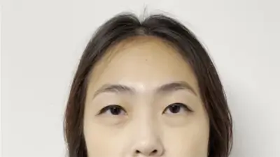 Botox Injections - Patient 1