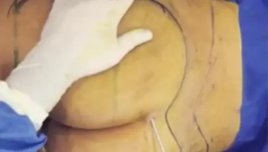 Brazilian Butt Lift Surgery Video: Patient 2