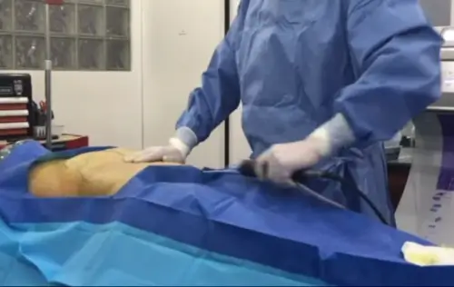 Brazilian Butt Lift Surgery Video: Patient 5