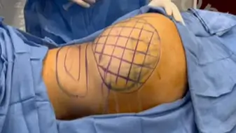 Brazilian Butt Lift Surgery Video: Patient 6