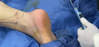 BodyTite Calf Liposuction