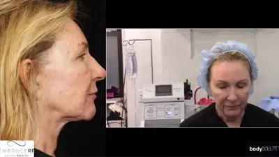 InMode Embrace-RF – An Innovative Option to Contour Your Face and Neck