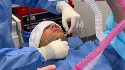 Embrace-RF with Dr. Christopher Chia under Local Anesthesia