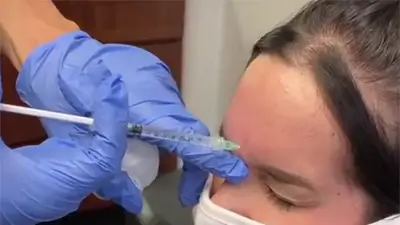 Botox Injections - Patient 2