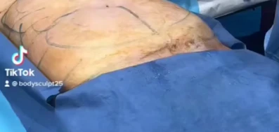 Female Abdomen Liposuction Video