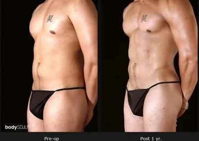 Gynecomastia – Before & After Photos