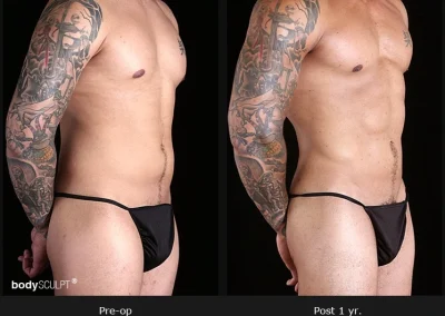 Gynecomastia – Before & After Photos