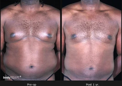 Gynecomastia – Before & After Photos