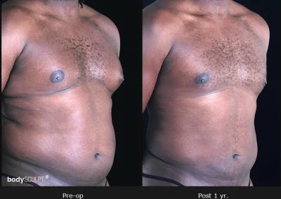 Gynecomastia – Before & After Photos