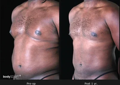 Gynecomastia – Before & After Photos
